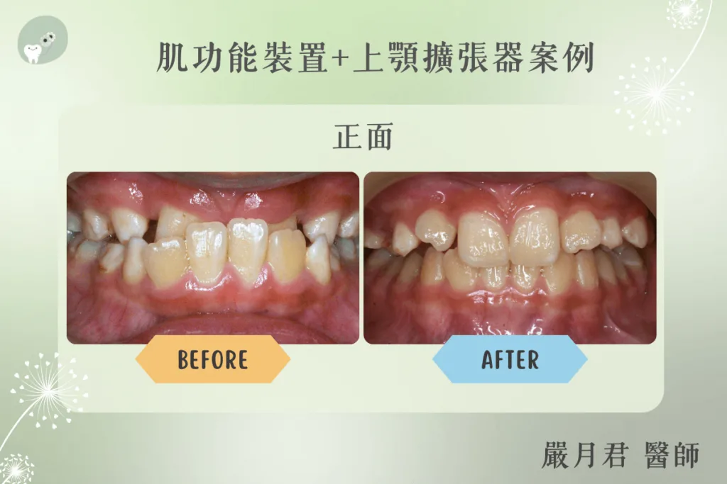 【案例分享】嚴月君醫師-肌功能矯正+上顎擴張器案例 1 orthodontics case 3 1