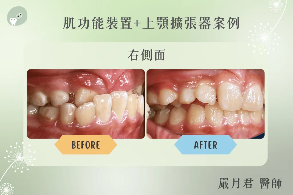 【案例分享】嚴月君醫師-肌功能矯正+上顎擴張器案例 2 orthodontics case 3 2