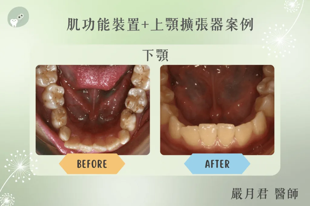 【案例分享】嚴月君醫師-肌功能矯正+上顎擴張器案例 4 orthodontics case 3 4