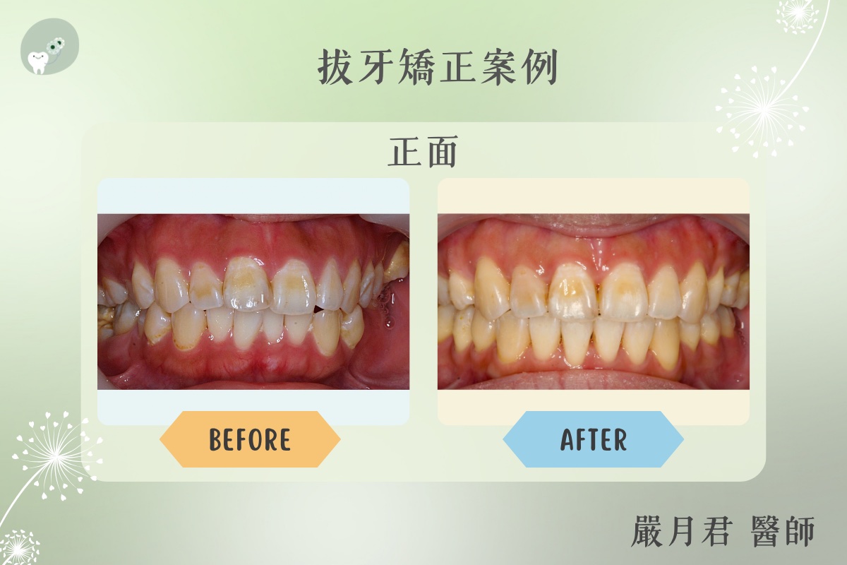 拔牙矯正 案例照片 1