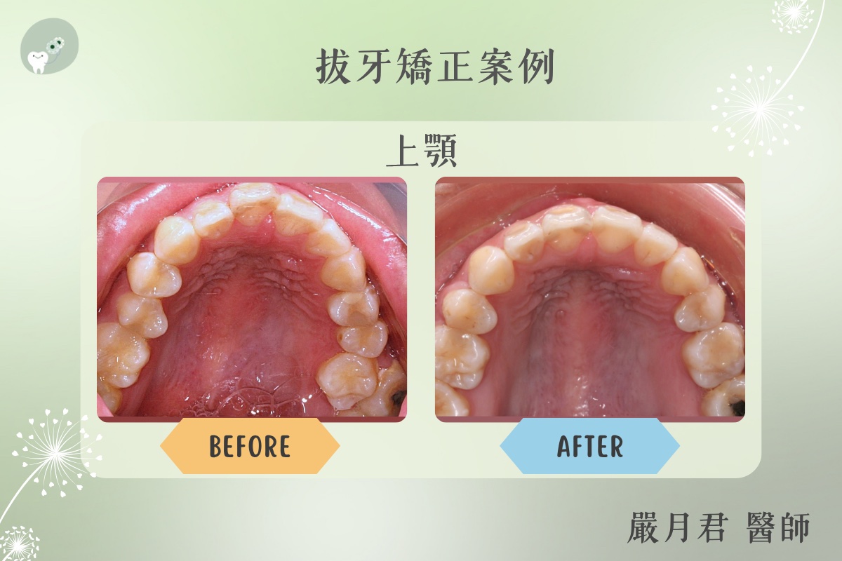 拔牙矯正 案例照片 2
