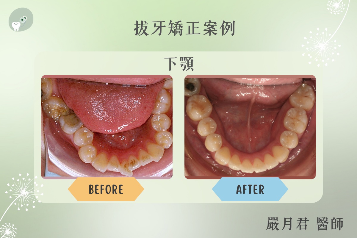 拔牙矯正 案例照片 3