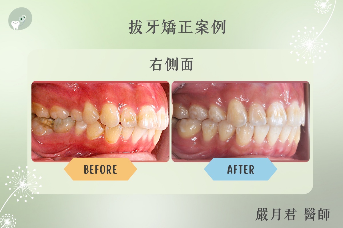 拔牙矯正 案例照片 4