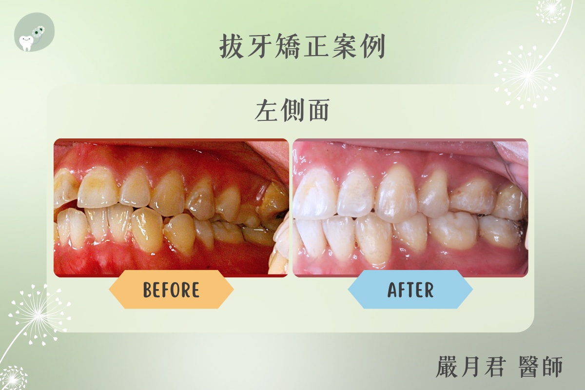 拔牙矯正 案例照片 5