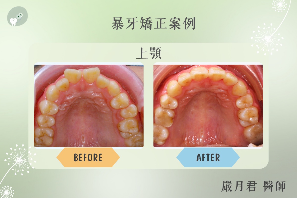 下顎後縮型暴牙 案例照片 2
