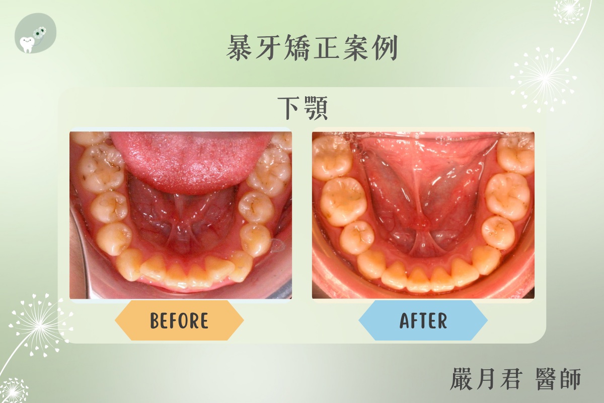 下顎後縮型暴牙 案例照片 3