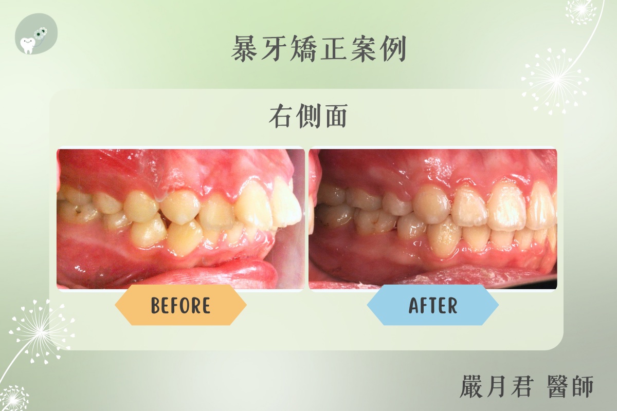 下顎後縮型暴牙 案例照片 4