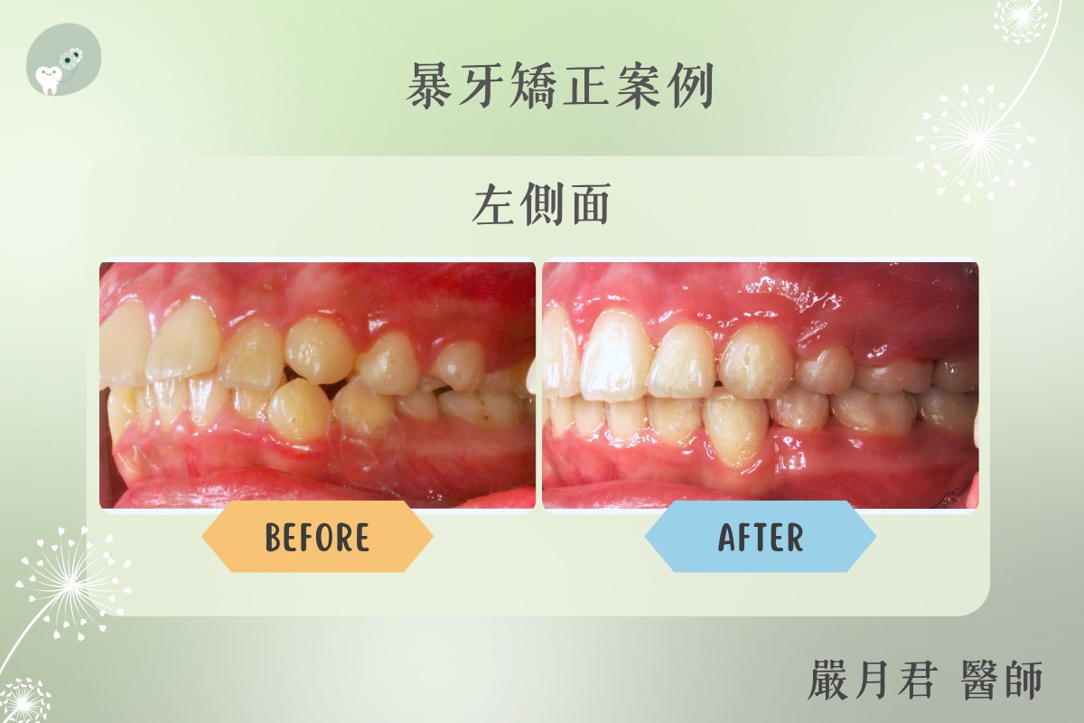 下顎後縮型暴牙 案例照片 5