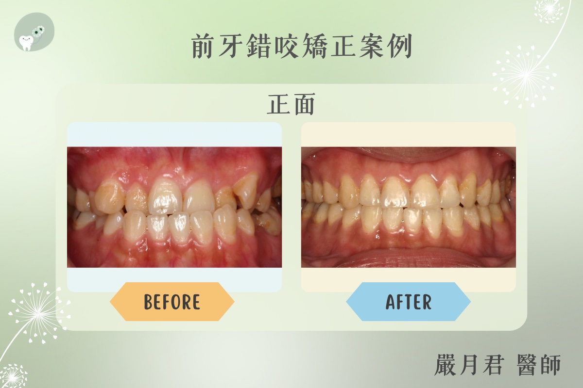 成人前牙錯咬矯正 案例照片 1