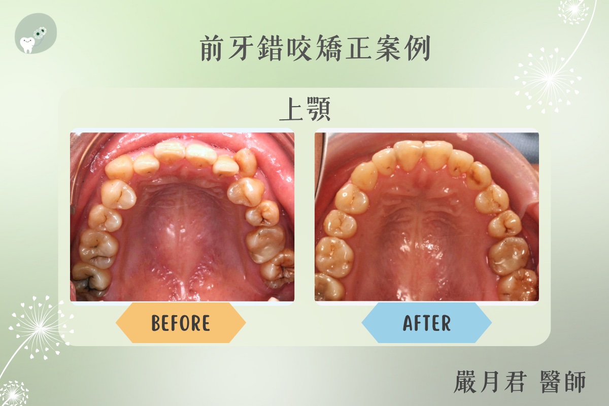 成人前牙錯咬矯正 案例照片 2