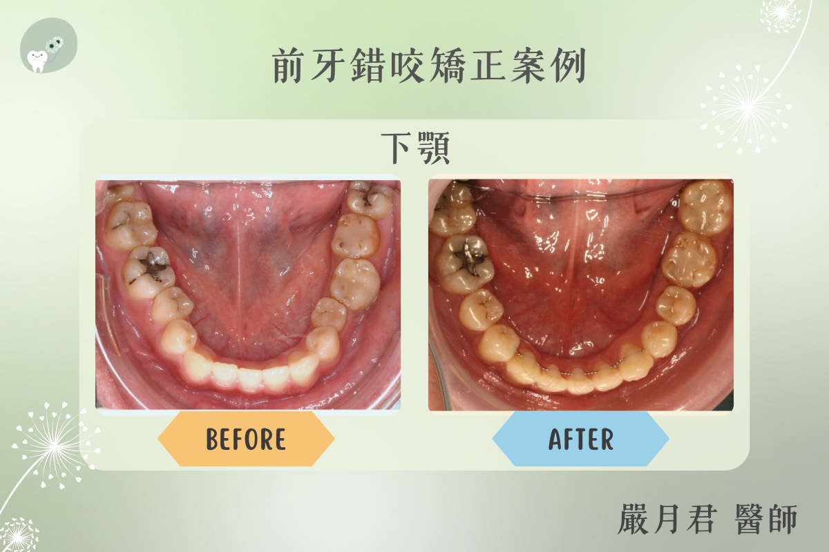 成人前牙錯咬矯正 案例照片 3