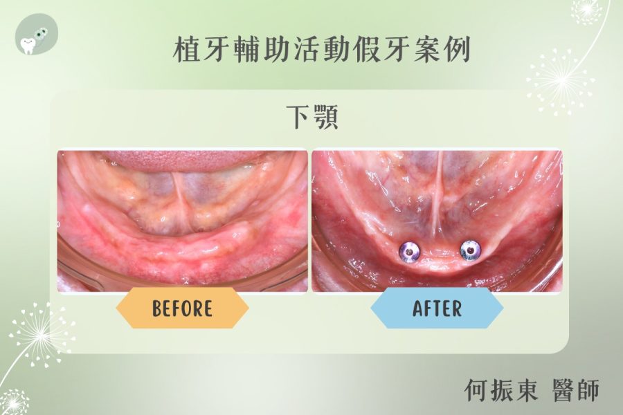 植牙輔助活動假牙 案例照片