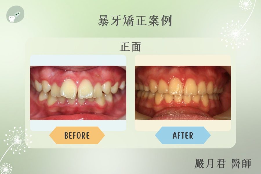 下顎後縮型暴牙 案例照片